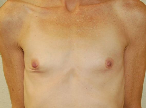 Breast Augmentation Case 446 - Before