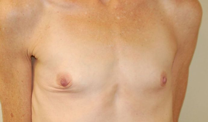 Breast Augmentation: Case 446 - Before