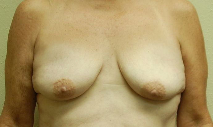 Breast Augmentation w/ Lift Case 222 - Before