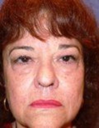 Lower Eyelid Surgery: Case 4 - Before Eyelid Surgery