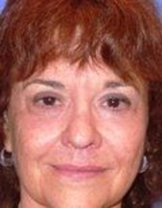 Lower Eyelid Surgery: Case 4 - After Eyelid Surgery