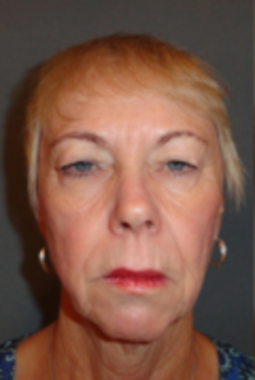 Lower Eyelid Surgery: Case 7 - Before Lower Eyelid Surgery