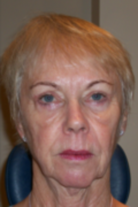 Lower Eyelid Surgery: Case 7 - After Lower Eyelid Surgery