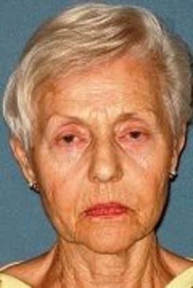 Lower Eyelid Surgery: Case 14 - Before Lower Eyelid Surgery