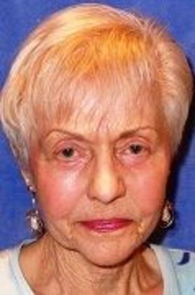 Lower Eyelid Surgery: Case 14 - After Lower Eyelid Surgery