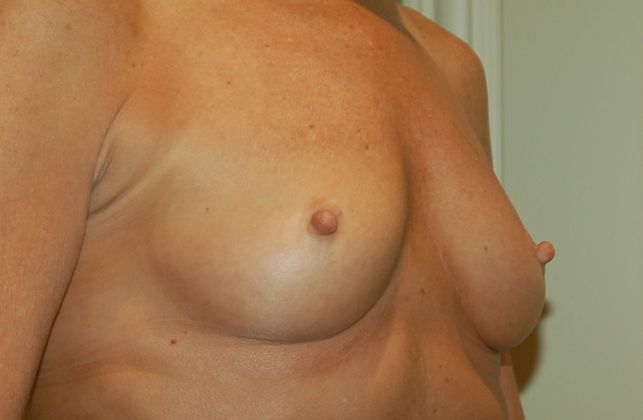 Breast Augmentation Case 449 - Before