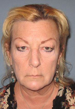 Lower Eyelid Surgery: Case 17 - Before Lower Eyelid Surgery