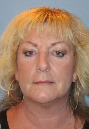 Lower Eyelid Surgery: Case 17 - After Lower Eyelid Surgery