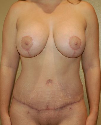 Mommy Makeover Case 93 - After