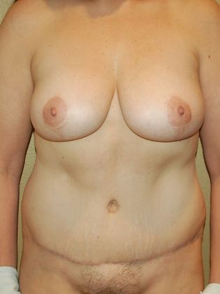 Mommy Makeover: Case 73 - After