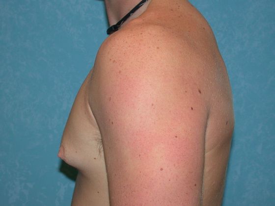 Gynecomastia G1025 - Perrysburg, OH - Before