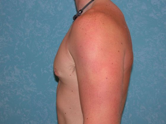 Gynecomastia G1025 - Perrysburg, OH - After