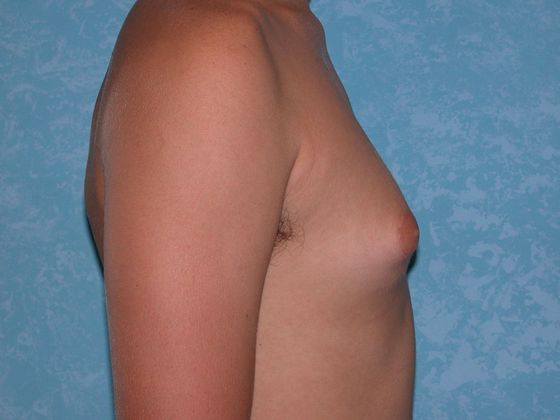 Gynecomastia G0920 - Bowling Green, OH - Before