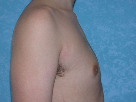 Gynecomastia G0920 - Bowling Green, OH - After