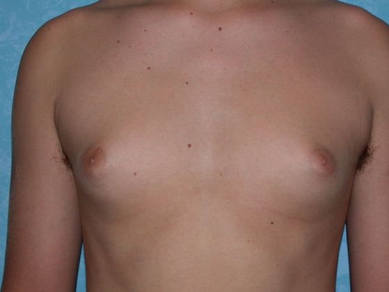 Gynecomastia: G0921 - Bowling Green, OH - Before