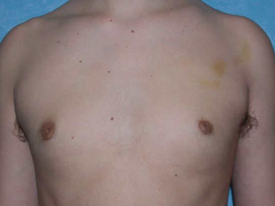 Gynecomastia: G0921 - Bowling Green, OH - After
