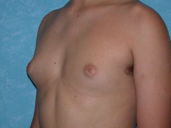 Gynecomastia: G0922 - Bowling Green, OH - Before
