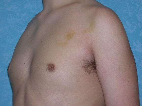 Gynecomastia: G0922 - Bowling Green, OH - After