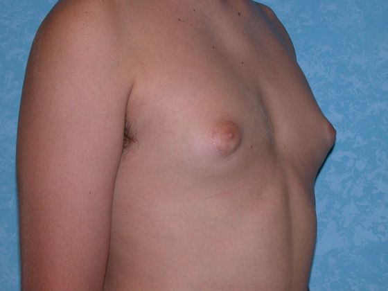 Gynecomastia G0923 - Bowling Green, OH - Before