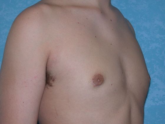 Gynecomastia G0923 - Bowling Green, OH - After