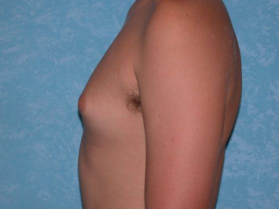 Gynecomastia G0924 - Bowling Green, OH - Before