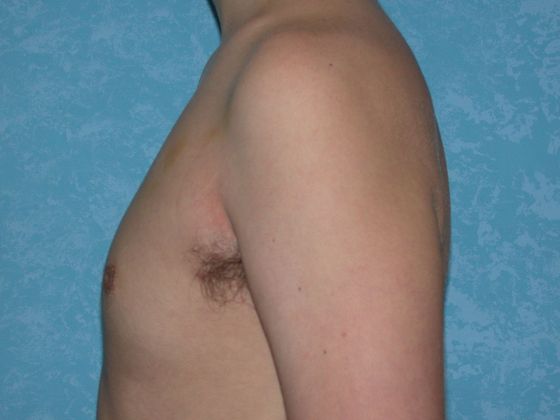 Gynecomastia G0924 - Bowling Green, OH - After