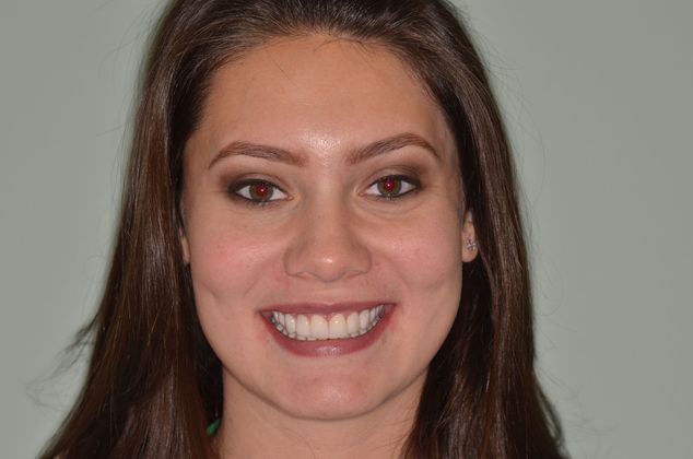 Composite Bonding: Case 4 - After composite bonding