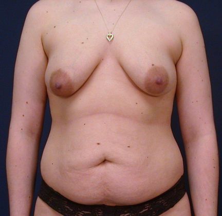 Mommy Makeover Case 2 - Before