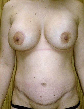 Mommy Makeover Case 2 - After