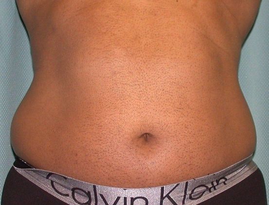 Liposuction Case 2 - Before