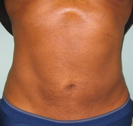 Liposuction Case 2 - After