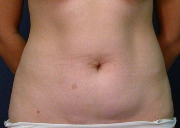 Liposuction Case 3 - Before