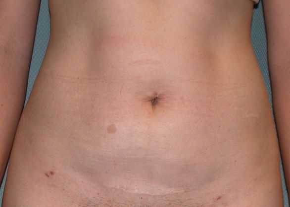 Liposuction Case 3 - After