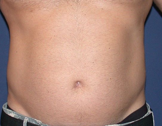 Liposuction Case 4 - Before