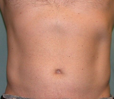 Liposuction Case 4 - After