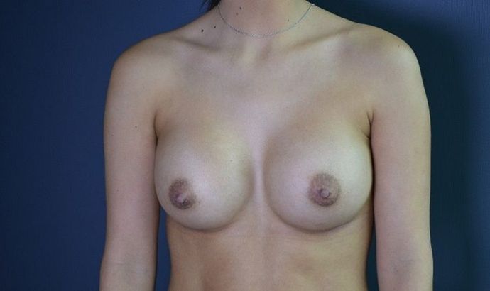 Breast Augmentation Case 5 - After