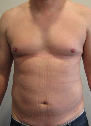 Liposuction: Case 9 - Liposuction, Norwalk - After
