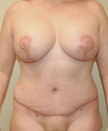 Mommy Makeover Case 97 - After