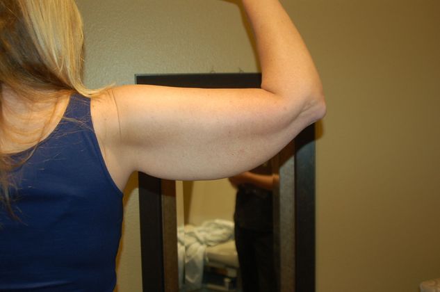 Brachioplasty Case 8 - Before