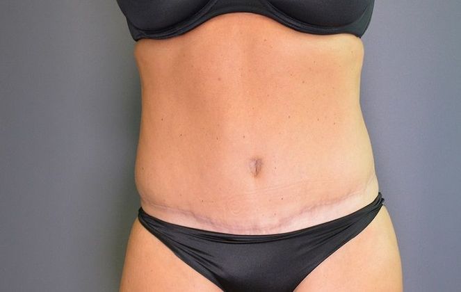 Tummy Tuck Case 1 - After