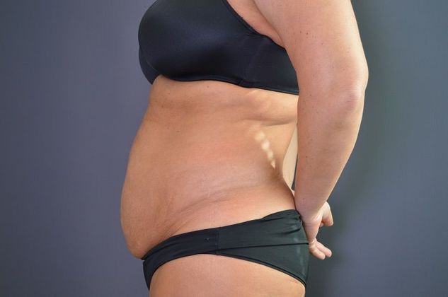 Tummy Tuck: Case 1 - Before