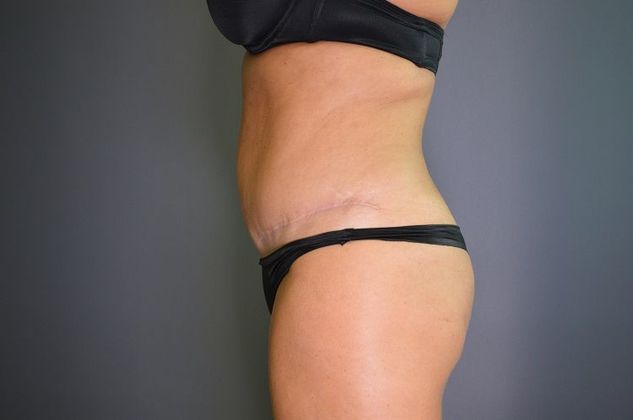 Tummy Tuck: Case 1 - After