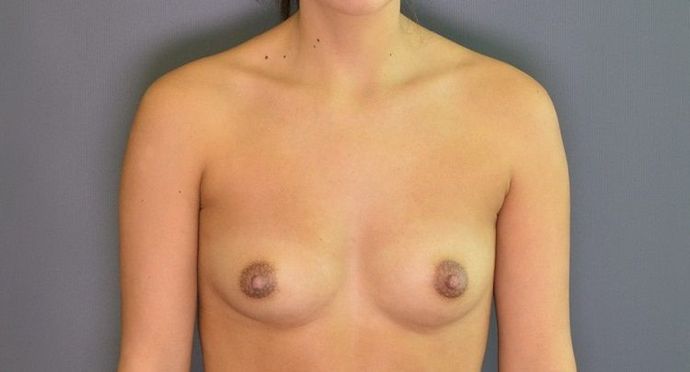 Breast Augmentation Case 5 - Before
