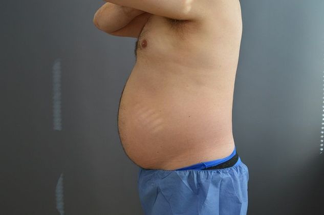 Liposuction Case 5 - Before