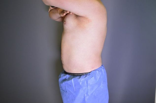 Liposuction Case 5 - After