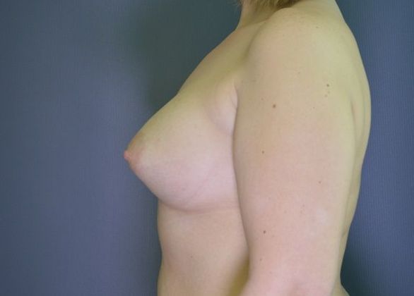 Breast Augmentation Case 7 - After