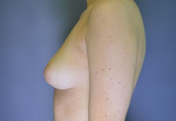 Breast Augmentation Case 8 - Before