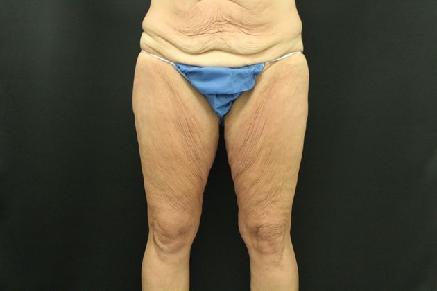 Thigh Lift Case 3 - Before