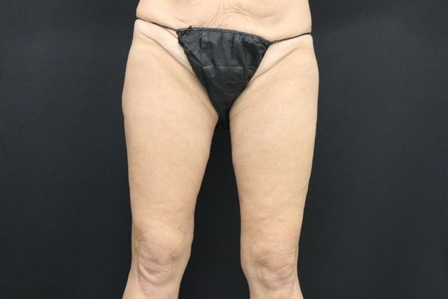 Thigh Lift Case 3 - After