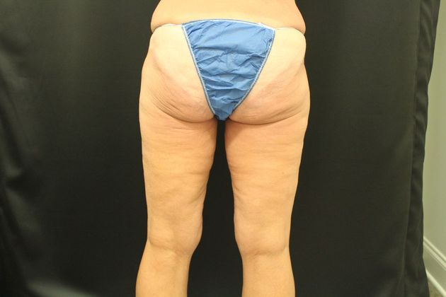 Thigh Lift: Case 3 - Before